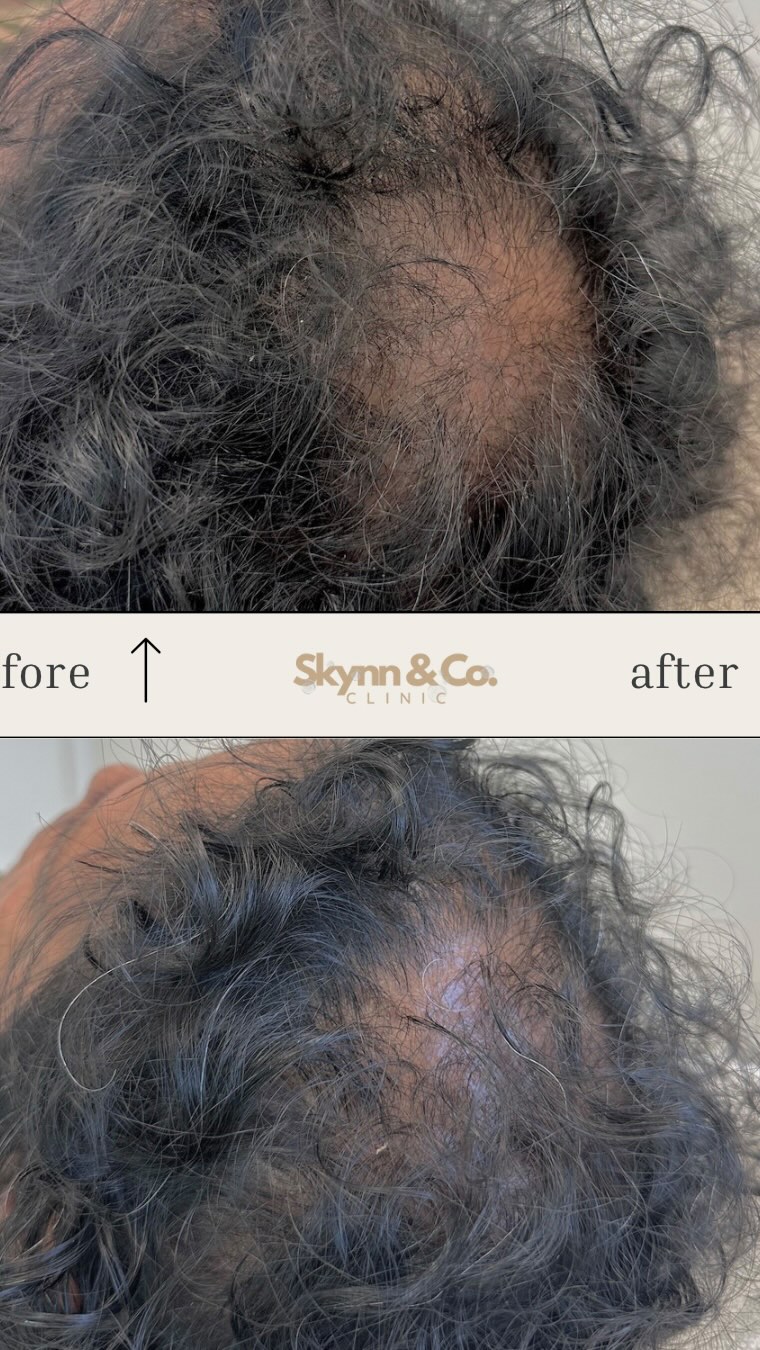 Haarverlies behandeling resultaat