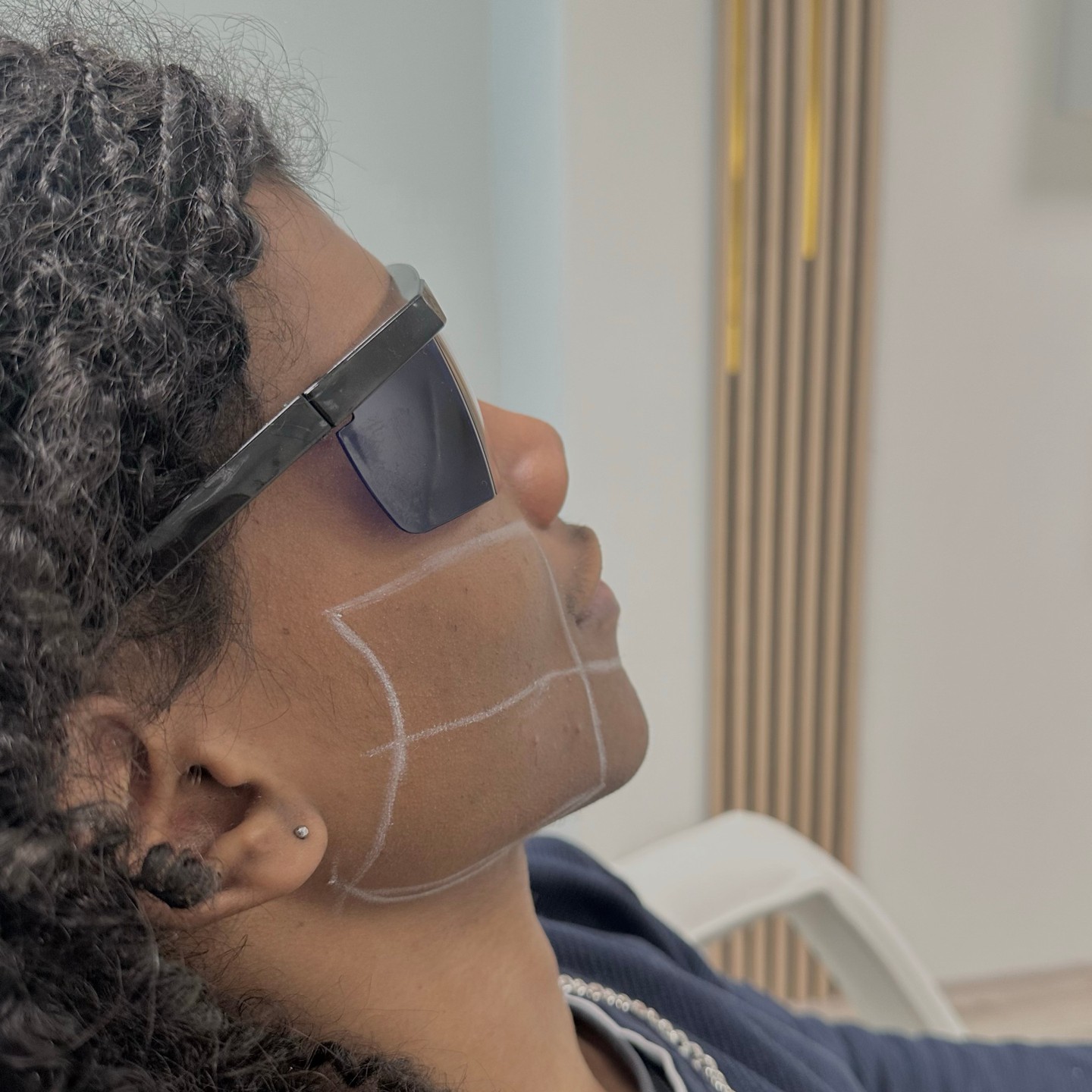 Laserbehandeling gezicht met markering