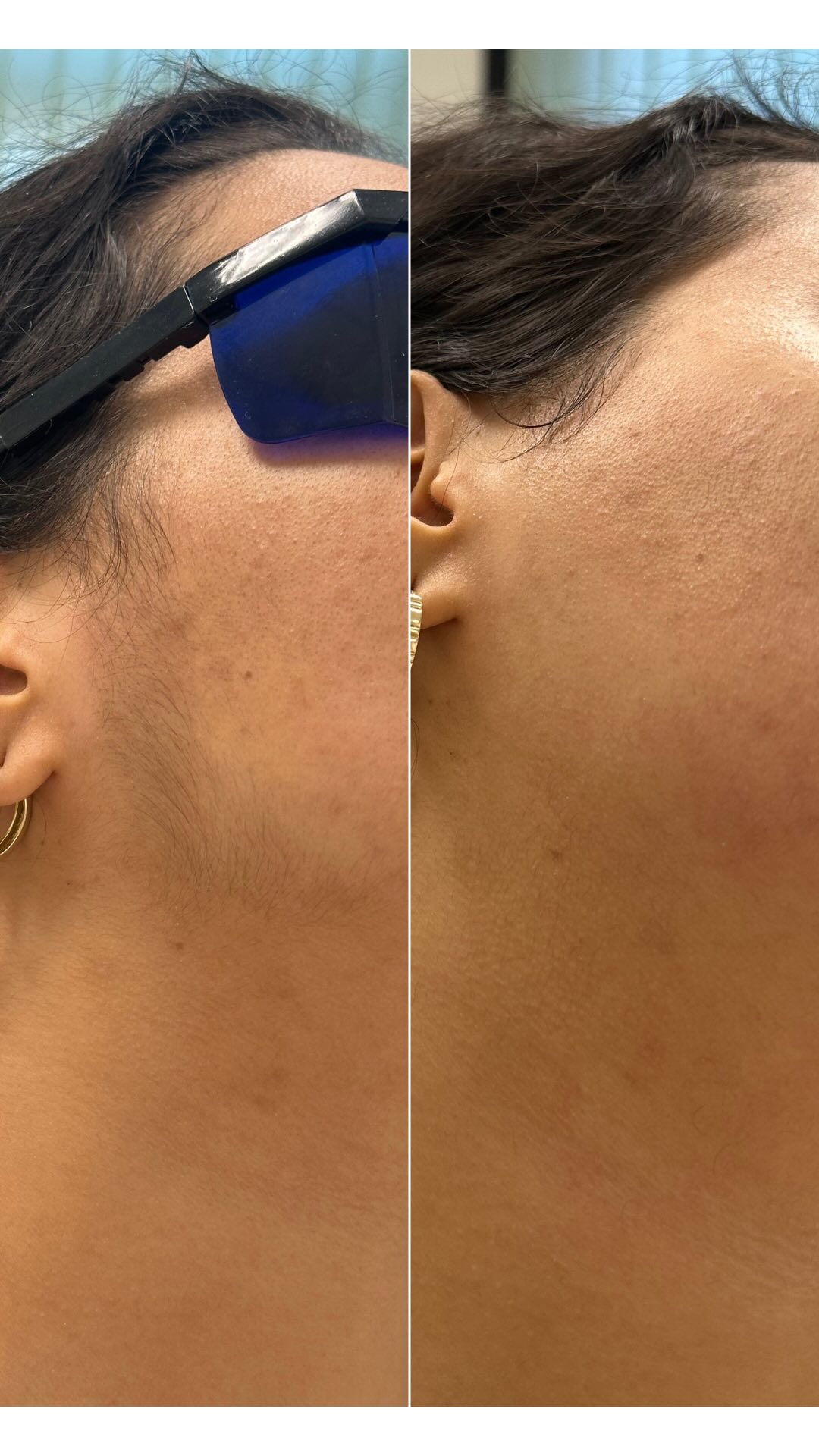 Laserontharing gezicht resultaat