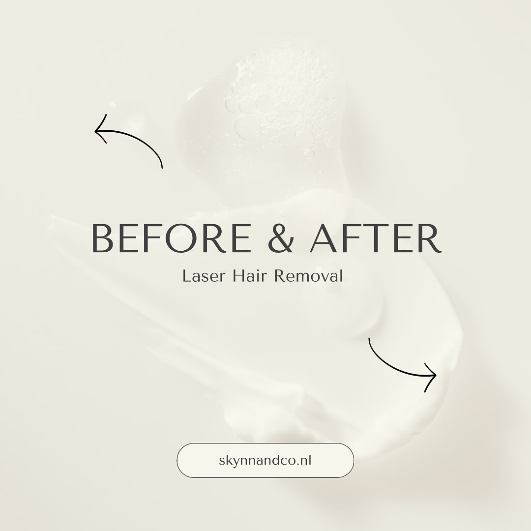 Laserontharing benen voorbereiding