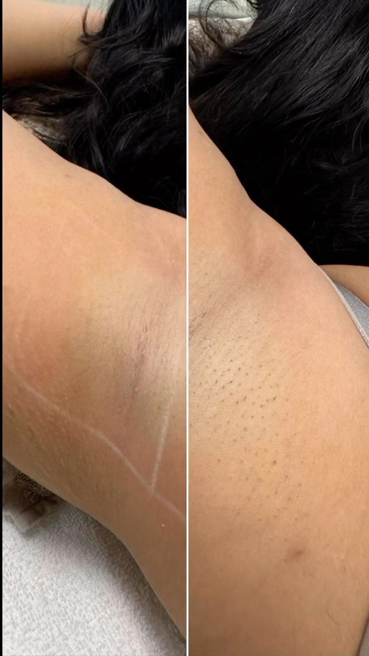 Laserontharing oksels resultaat