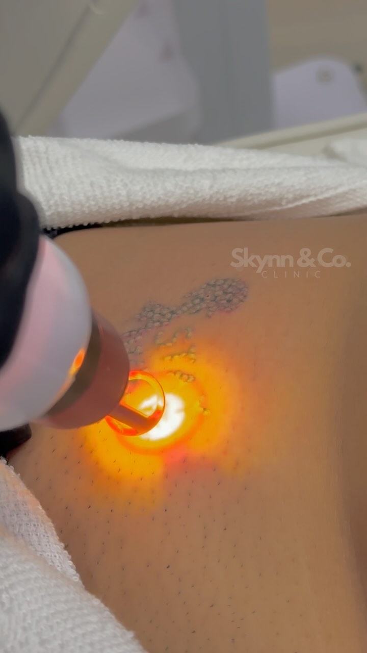 Laserontharing bij Skynn & Co. Clinic