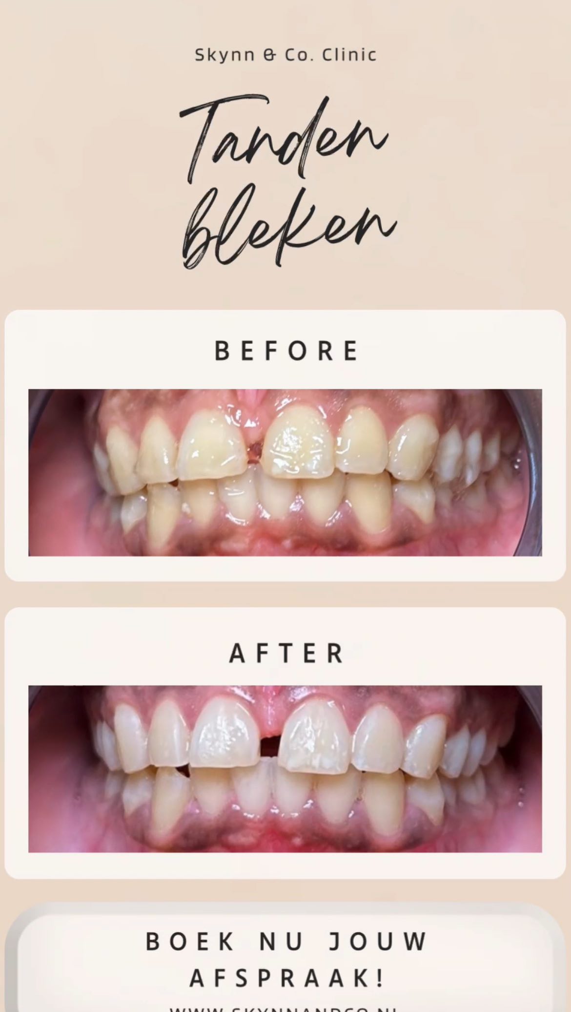 Tanden bleken resultaat