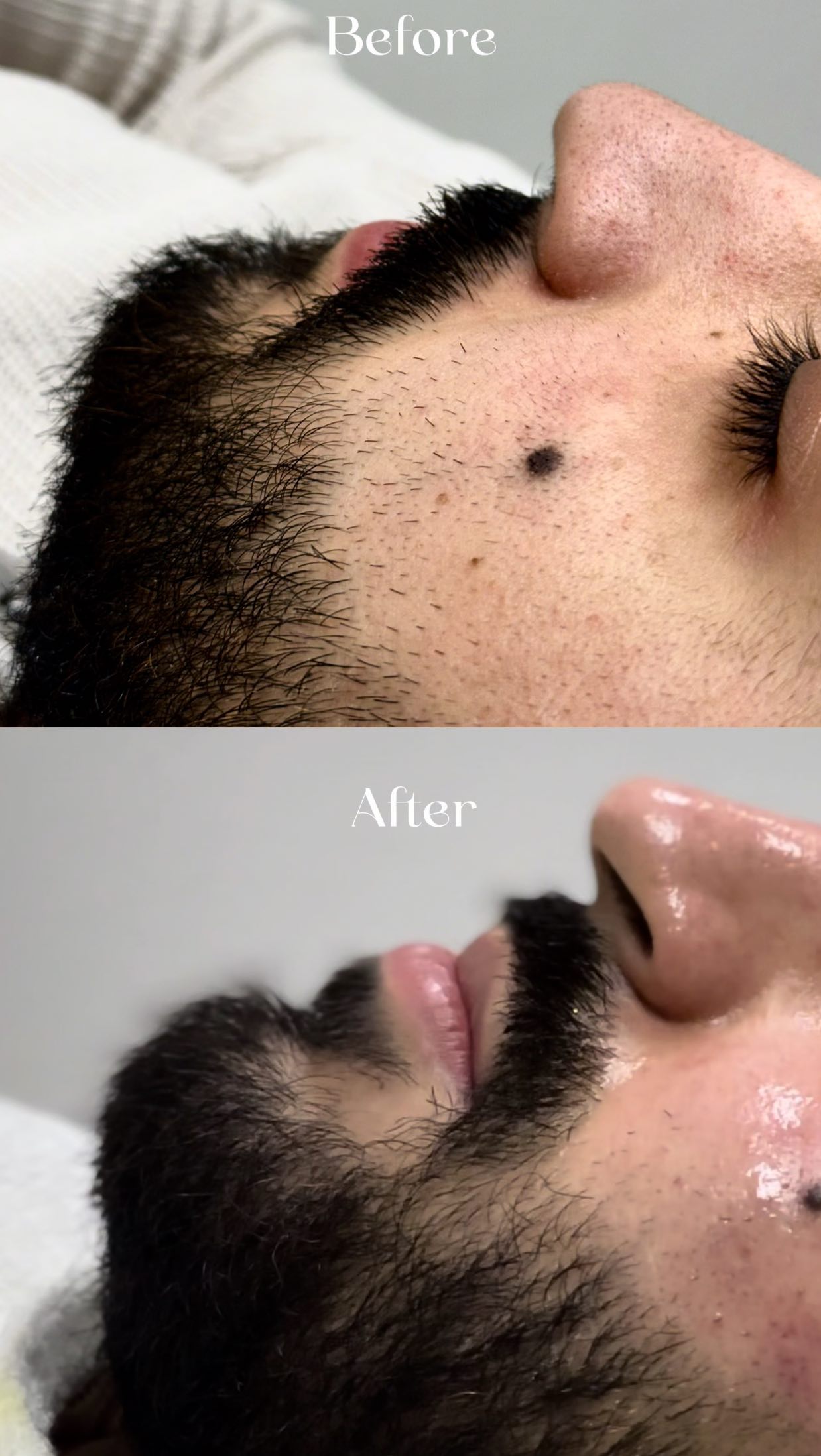 Gezichtsbehandeling resultaat