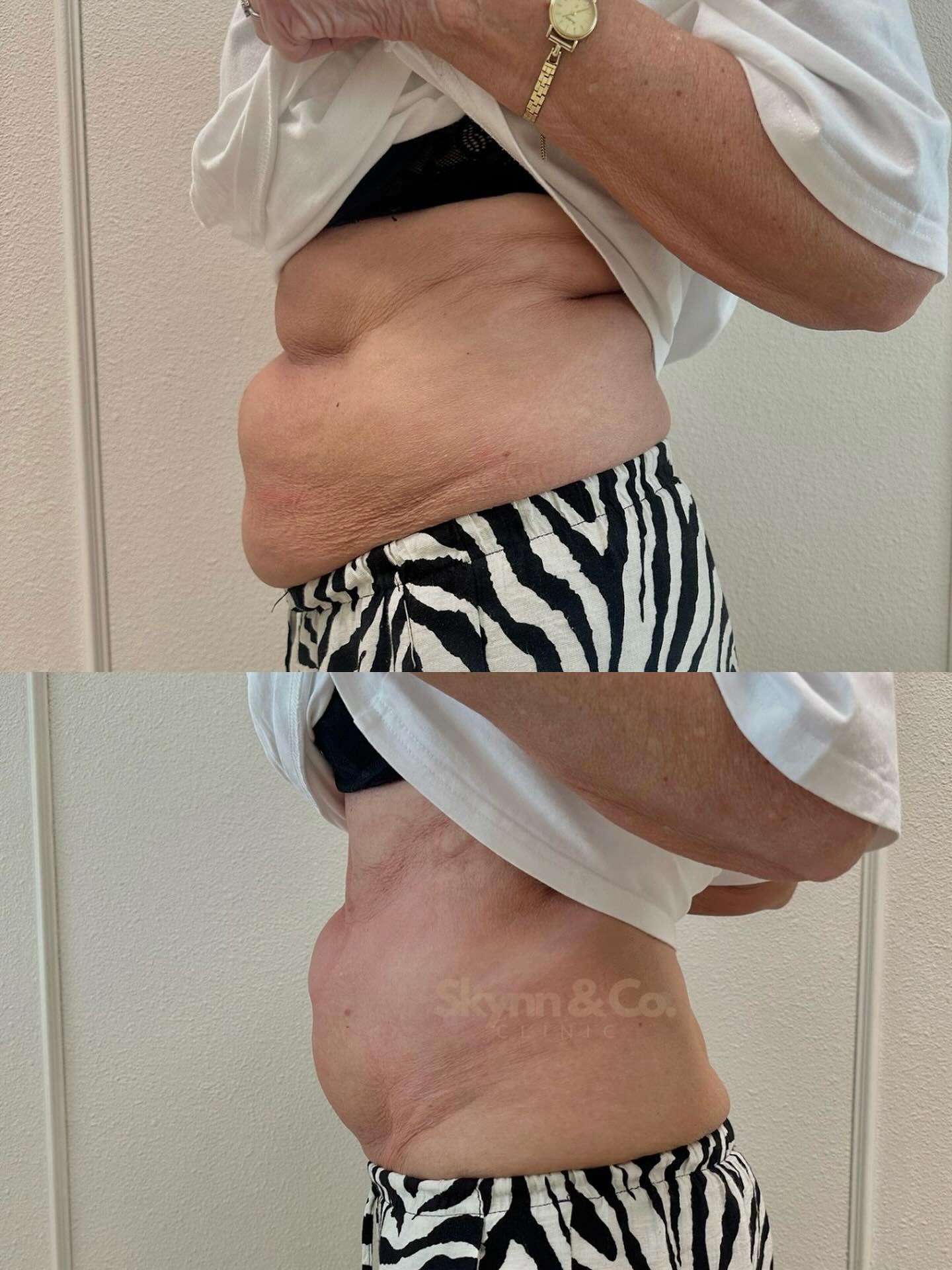 Fat Freeze resultaat voor en na